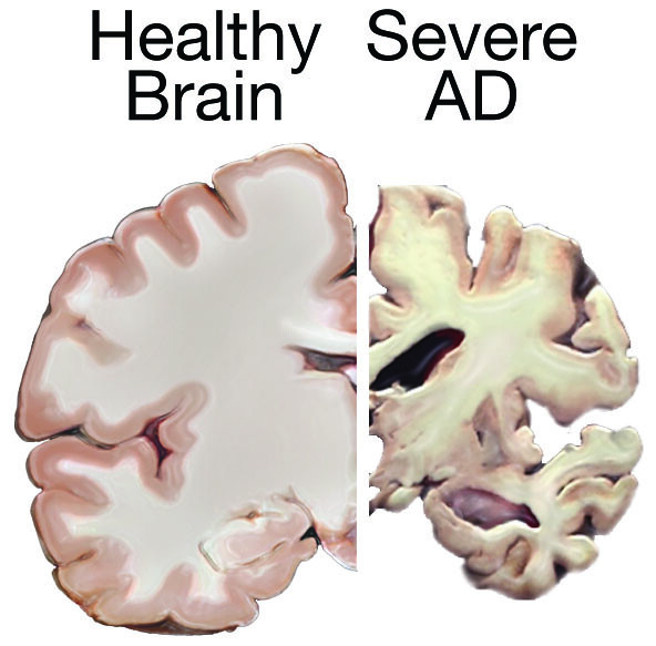 brain from a healthy person vs someone with advanced Alzheimer's showing tissue atrophy brain from a healthy person vs someone with advanced Alzheimer's showing tissue atrophy