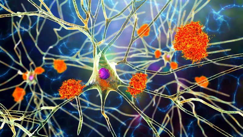 3d rendering of amyloid plaques near a neuron in the brain