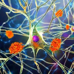 3d rendering of amyloid plaques near a neuron in the brain