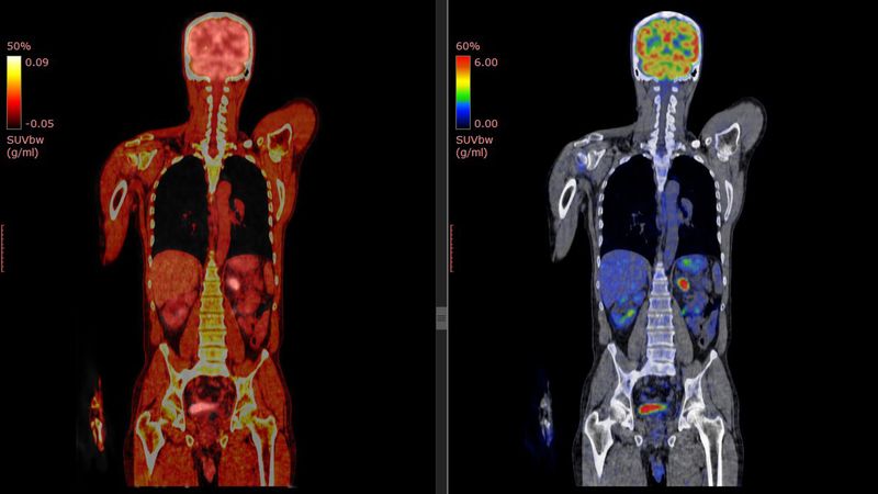 PET CT Scan of the human body.
