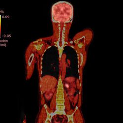 PET CT Scan of the human body.