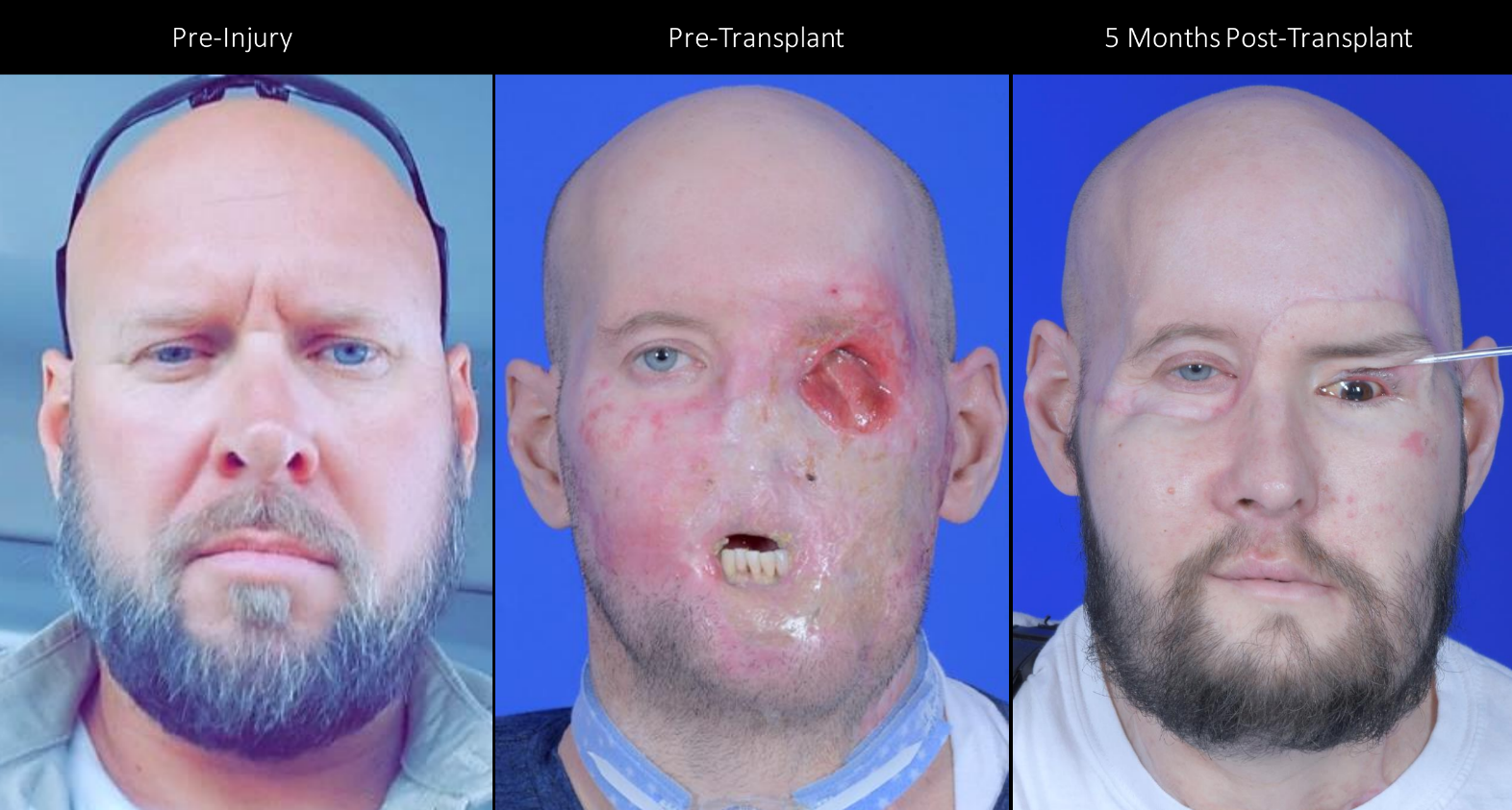 Aaron James after his injury, pre-transplant, and after his face tranplant. Aaron James after his injury, pre-transplant, and after his face tranplant.
